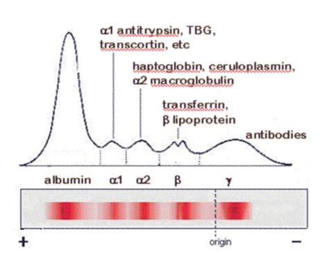 interpreting electrophoresis results|Understanding and Interpreting Serum Protein Electrophoresis.